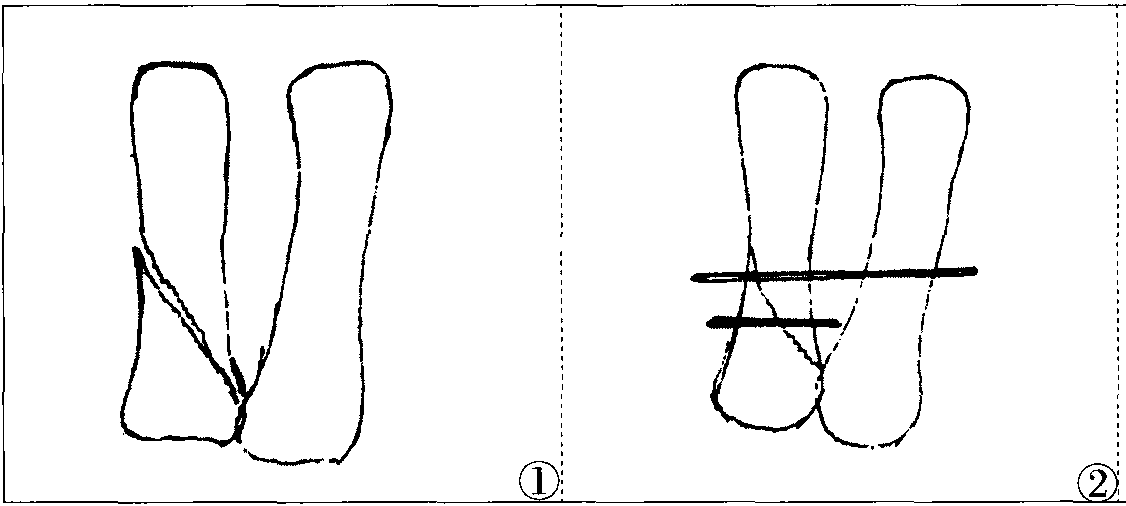 掌骨骨折